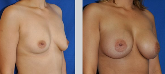 Flash Recovery Breast Augmentation TM before 253887