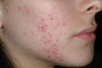 Acne and Isolaz before 95914