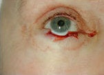 Eyelid skin cancer reconstruction before 84502