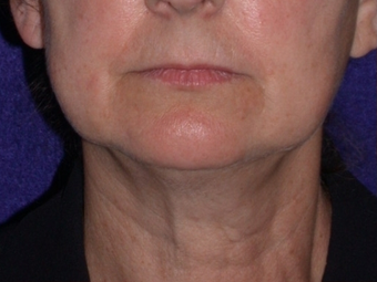 Necklift before 208445
