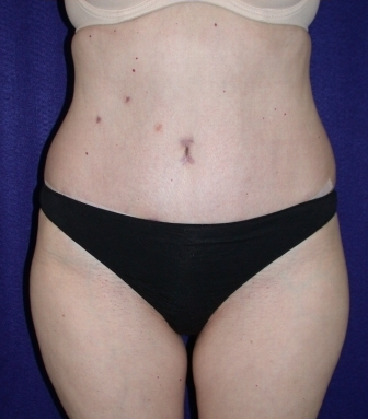 Tummy Tuck (abdominoplasty) after 208465