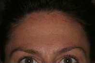 Botox after 317712