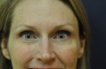 Botox after 622166