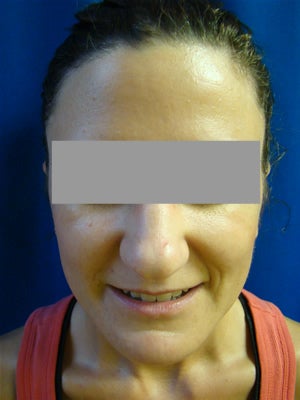 Ear Surgery (Otoplasty) after 128113