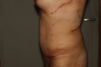 Abdominoplasty-Tummy Tuck with Liposuction after 607275