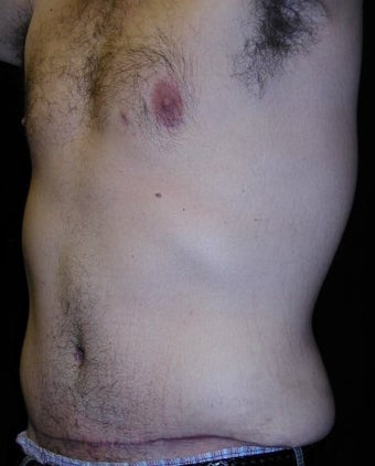 Male tummy Tuck, Flank Liposuction, Male Breast Reduction 578158