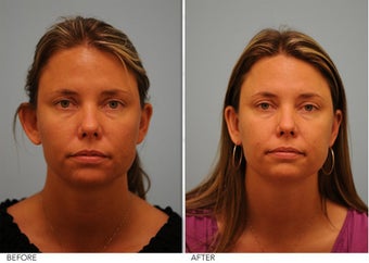Otoplasty before 306851