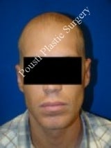 Ear Surgery (Otoplasty) 616669