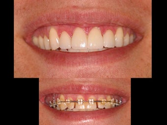 Whitening and porcelain veneers before 119939