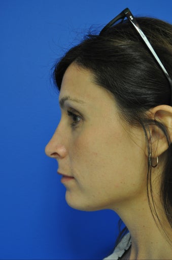 Nose surgery/Rhinoplasty after 498393