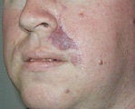 Pulsed Dye Laser after 478044