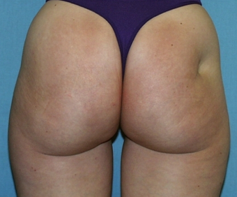 Fat Transfer before 275688