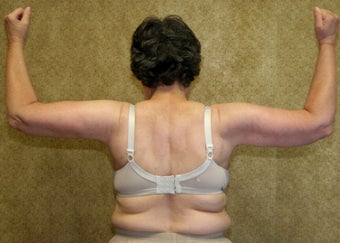 Brachioplasty or arm tuck in los angeles after 583674