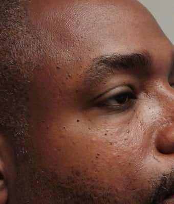 removal of dermatosis papulos nigra before 298228