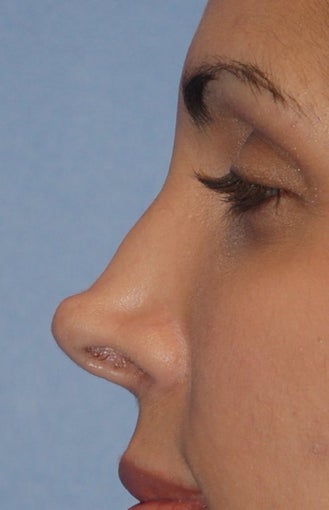 Non-surgical Revision Rhinoplasty before 91086