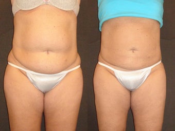 SmartLipo before 96258