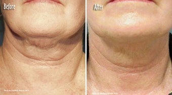 Thermage to Neck, chin and jaw line before 6576