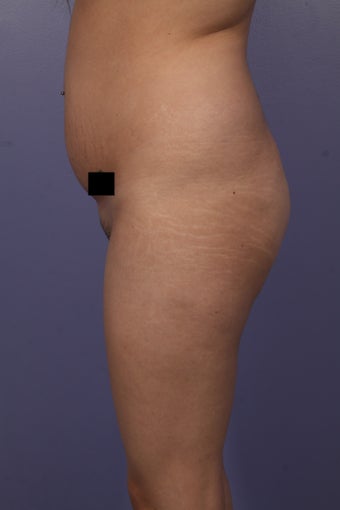 Buttock augmentation before 585019