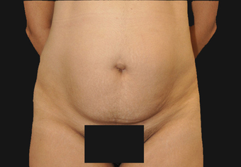 Andominoplasty 458930