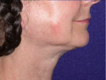 Necklift 208445