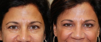 BOTOX Cosmetic: 3 areas before 130671