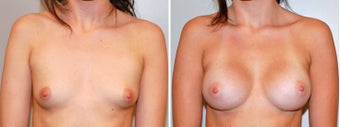 Breast augmentation before 330264