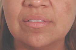 Restylane for laugh lines before 91653