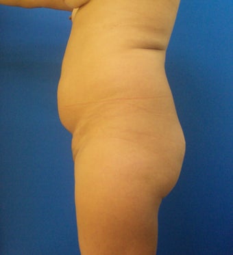 Brazilian Butt lift 366996