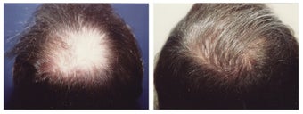 hair transplant before 369164