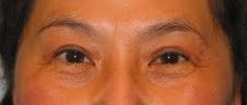 Asian Eyelid Surgery after 613747