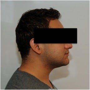 Smartlipo Neck after 123639