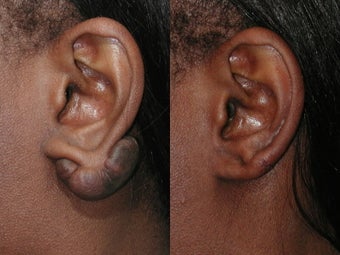 Keloid Excision before 137721