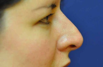 Non-Surgical Rhinoplasty after 513480