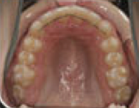 Damon System Braces 477299