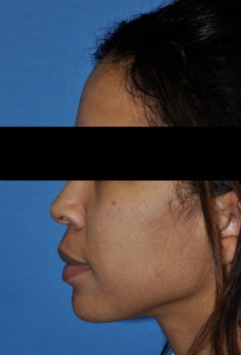 African American Rhinoplasty before 364920