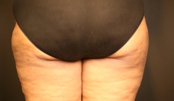 Cellulite Treatment after 602206