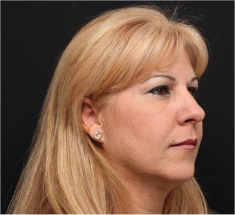 Restylane & Juvederm 444312
