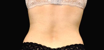 CoolSculpting after 483049