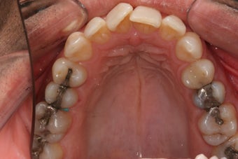 Invisalign before 372721