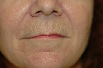 Laser skin resurfacing, eyelid surgery, lip augmentation 434871