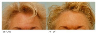 Botox before 138526