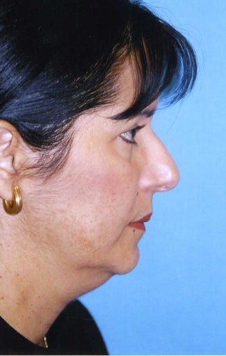 Chin Implant before 409957