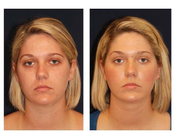 Chin Lipo before 347523