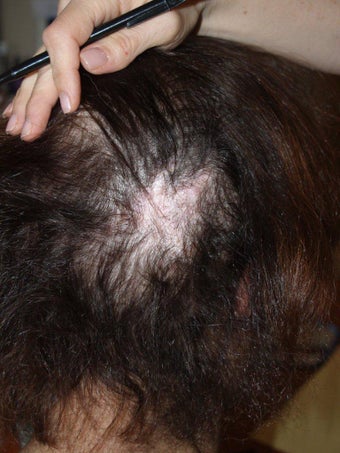 Hair Transplant to Prior Scar after 331296