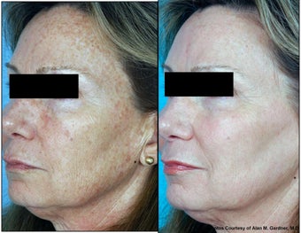 Laser Resurfacing before 130551