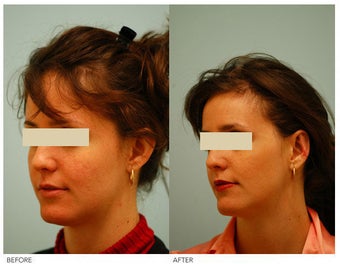 Otoplasty (Cosmetic Ear Pinning) before 136399