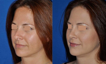 Revision Rhinoplasty before 293543