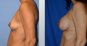 Breast Augmentation before 256384