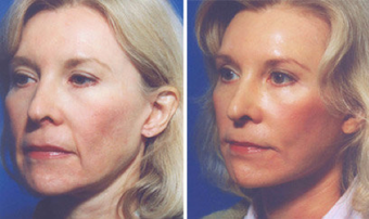 Cheek Lift and Augmentation before 296654