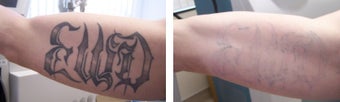 Laser tattoo removal before 369208